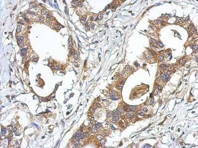 Immunohistochemistry-Paraffin: GPRASP2 Antibody [NBP2-16729] - Immunohistochemical analysis of paraffin-embedded Gastric ca, using antibody at 1:500 dilution.