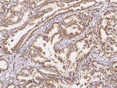 Immunohistochemistry-Paraffin: GPRASP2 Antibody [NBP2-97143] - Immunochemical staining of human GPRASP2 in human gastric cancer with rabbit polyclonal antibody at 1:300 dilution, formalin-fixed paraffin embedded sections.