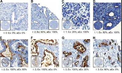 Immunohistochemistry Free-Floating: GPRC5A/RAI3 Antibody [NBP1-89743] - Expression of RAI3 in human tissue and cell lines. Immunochemistry with RAI3-Antibody in different types of pancreatic tissue. Presentation in 20-fold magnification of A-C: Normal; D: Chronic pancreatits (CP), E: Intraductal Papillary Mucinous Neoplasm (IPMN); F-H: Pancreatic Ductal Adenocarcinoma (PDAC). (PLoS One. 2017; 12 (1): e0170390. Published online 2017 Jan 23.)