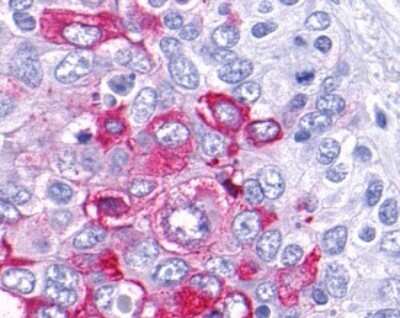 Immunohistochemistry-Paraffin: GPRC5C Antibody [NLS4077] - Analysis of anti-GPRC5C antibody with human lung, non-small cell carcinoma.