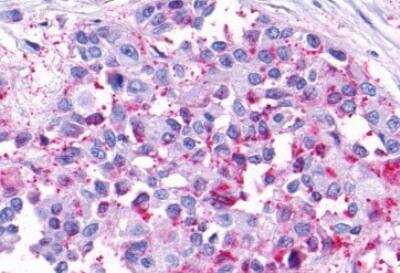 Immunohistochemistry-Paraffin: GPRC5C Antibody [NLS4077] - Human pancreas, carcinoma. Immunohistochemistry of formalin-fixed, paraffin-embedded tissue after heat-induced antigen retrieval.