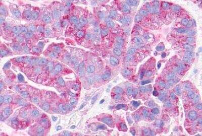 Immunohistochemistry-Paraffin: GPRC5C Antibody [NLS4077] - Human Ovary, Carcinoma. Immunohistochemistry of formalin-fixed, paraffin-embedded tissue after heat-induced antigen retrieval.