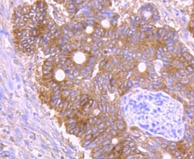 Immunohistochemistry-Paraffin: GRASP65 Antibody (JB36-34) [NBP2-75516] - Analysis of paraffin-embedded human colon cancer tissue using anti-GRASP65 antibody. Counter stained with hematoxylin.