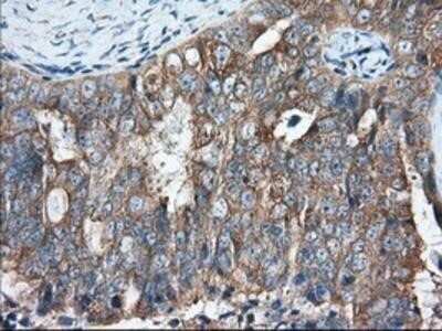 Immunohistochemistry: GRASP65 Antibody (OTI5G8) - Azide and BSA Free [NBP2-72144] - Staining of paraffin-embedded Adenocarcinoma of Human ovary tissue using anti-GRASP65 mouse monoclonal antibody.