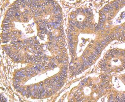 Immunohistochemistry-Paraffin: GRB2 Antibody (11-B11) [NBP2-80405] - Analysis of human colon cancer tissue using GRB2 antibody. Counter stained with hematoxylin.
