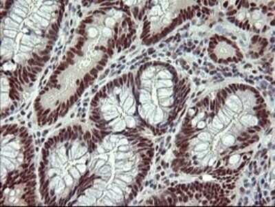 Immunohistochemistry: GRF2 Antibody (OTI2F5) - Azide and BSA Free [NBP2-70846] - Analysis of Adenocarcinoma of Human colon tissue. (Heat-induced epitope retrieval by 10mM citric buffer, pH6.0, 120C for 3min)