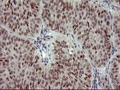 Immunohistochemistry: GRF2 Antibody (OTI2F5) - Azide and BSA Free [NBP2-70846] - Analysis of Adenocarcinoma of Human ovary tissue. (Heat-induced epitope retrieval by 10mM citric buffer, pH6.0, 120C for 3min)