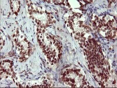 Immunohistochemistry: GRF2 Antibody (OTI2F5) - Azide and BSA Free [NBP2-70846] - Analysis of Carcinoma of Human prostate tissue. (Heat-induced epitope retrieval by 10mM citric buffer, pH6.0, 120C for 3min)