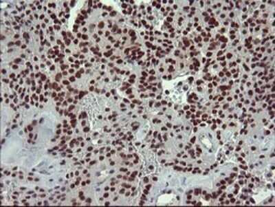 Immunohistochemistry: GRF2 Antibody (OTI2F5) - Azide and BSA Free [NBP2-70846] - Analysis of Carcinoma of Human thyroid tissue. (Heat-induced epitope retrieval by 10mM citric buffer, pH6.0, 120C for 3min)