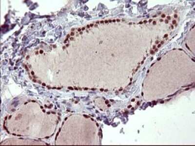 Immunohistochemistry: GRF2 Antibody (OTI2F5) - Azide and BSA Free [NBP2-70846] - Analysis of Human thyroid tissue. (Heat-induced epitope retrieval by 10mM citric buffer, pH6.0, 120C for 3min)