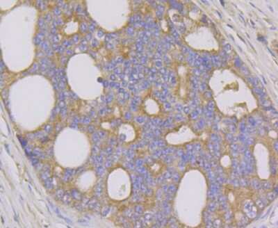 Immunohistochemistry-Paraffin: GRIM19 Antibody (JG82-33) [NBP2-75517] - Analysis of paraffin-embedded human prostate cancer tissue using anti-GRIM19 antibody. Counter stained with hematoxylin.
