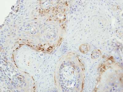 Immunohistochemistry-Paraffin: GRK2 Antibody [NBP1-32534] - Paraffin-embedded Cal27 xenograft, using antibody at 1:500 dilution.