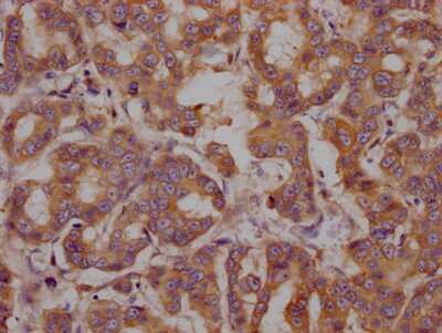 Immunohistochemistry: GRP78/HSPA5 Antibody (4H12) [NBP3-15138] - IHC image of GRP78/HSPA5 antibody diluted at 1:100 and staining in paraffin-embedded human breast cancer. After dewaxing and hydration, antigen retrieval was mediated by high pressure in a citrate buffer (pH 6.0). Section was blocked with 10% normal goat serum 30 minutes at RT. Then primary antibody (1% BSA) was incubated at 4C overnight. The primary is detected by a Goat anti-rabbit IgG polymer labeled by HRP and visualized using 0.05% DAB.