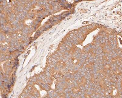 Immunohistochemistry-Paraffin: GSDMDC1 Antibody [NBP2-80427] - Analysis in human prostate carcinoma tissue using GSDMDC1 antibody. The section was pre-treated using heat mediated antigen retrieval with sodium citrate buffer (pH 6.0) for 20 minutes. The tissues were blocked in 5% BSA for 30 minutes at room temperature