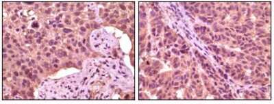 Immunohistochemistry-Paraffin: GSK-3 alpha Antibody (6G2F1) [NBP1-47500] - Analysis of human lung carcinoma (left) and skin carcinoma (right), showing cytoplasmic localization using GSK3 aphpa mouse mAb with DAB staining.