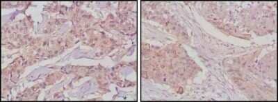 Immunohistochemistry-Paraffin: GSK-3 beta Antibody (3D10) - Azide and BSA Free [NBP2-80757] - Analysis of paraffin-embedded human lung cancer (left) and breast cancer tissues (right) using GSK3 beta mouse mAb with DAB staining. Image from the standard format of this antibody.