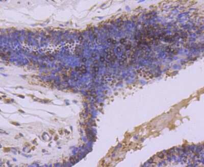 Immunohistochemistry-Paraffin: GSK-3 beta Antibody (SY28-03) [NBP2-67448] - Analysis of paraffin-embedded human breast carcinoma tissue using anti-GSK3 beta antibody. Counter stained with hematoxylin.