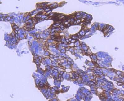 Immunohistochemistry-Paraffin: GSK-3 beta [p Ser9] Antibody (SY02-71) [NBP2-67444] - Analysis of paraffin-embedded human colon cancer tissue using anti-Phospho-GSK3 beta(Ser 9) antibody. Counter stained with hematoxylin.