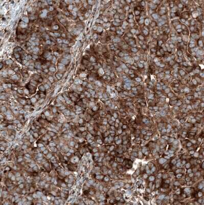 Immunohistochemistry-Paraffin: GSPT1 Antibody (CL13332) [NBP3-18565] - Staining of human ovarian cancer (papillary carcinoma) shows strong cytoplasmic positivity in tumor cells.