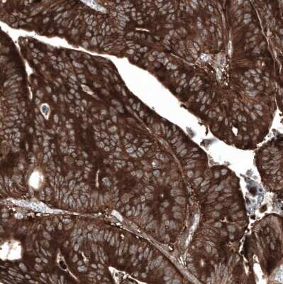 Immunohistochemistry-Paraffin: GSPT1 Antibody (CL13332) [NBP3-18565] - Staining of human colorectal cancer (metastasis to ovary) shows strong cytoplasmic positivity in tumor cells.