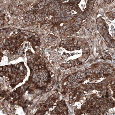 Immunohistochemistry-Paraffin: GSPT1 Antibody (CL13332) [NBP3-18565] - Staining of human colorectal cancer shows strong cytoplasmic positivity in tumor cells.