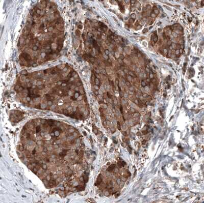 Immunohistochemistry-Paraffin: GSPT1 Antibody (CL13336) [NBP3-18559] - Staining of human breast cancer shows strong cytoplasmic positivity in tumor cells.