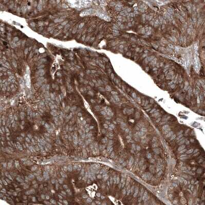 Immunohistochemistry-Paraffin: GSPT1 Antibody (CL13336) [NBP3-18559] - Staining of human colorectal cancer (metastasis to ovary) shows strong cytoplasmic positivity in tumor cells.