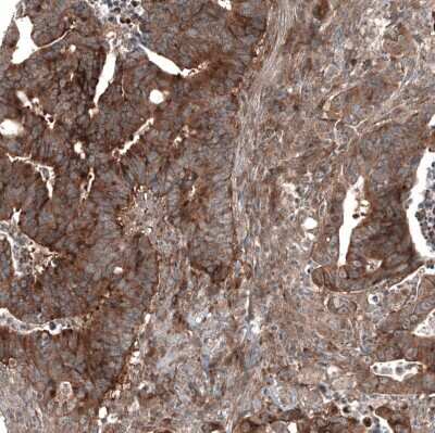 Immunohistochemistry-Paraffin: GSPT1 Antibody (CL13336) [NBP3-18559] - Staining of human colorectal cancer shows moderate to strong cytoplasmic positivity in tumor cells.