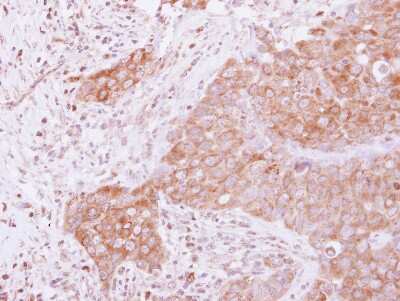 Immunohistochemistry-Paraffin: GSPT1 Antibody [NBP2-16754] - Human breast cancer, using GSPT1 antibody at 1:500 dilution.  Antigen Retrieval: Trilogy™ (EDTA based, pH 8.0) buffer, 15min