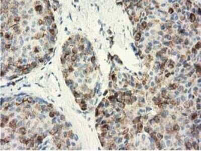 Immunohistochemistry: GSTA4 Antibody (OTI3F5) - Azide and BSA Free [NBP2-70856] - Staining of paraffin-embedded Adenocarcinoma of Human breast tissue using anti-GSTA4 mouse monoclonal antibody at 1:150