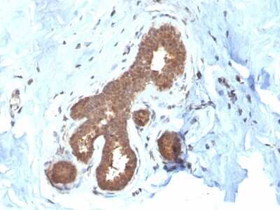 Immunohistochemistry-Paraffin: GSTM2 Antibody (CPTC-GSTMu2-2) [NBP3-07346] - Formalin-fixed, paraffin-embedded human Breast Carcinoma stained with GSTM2 Mouse Monoclonal Antibody (CPTC-GSTM2-2).