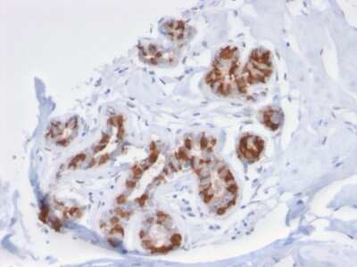 Immunohistochemistry-Paraffin: GSTM3 Antibody (CPTC-GSTMu3-1) [NBP3-08256] - Formalin-fixed, paraffin-embedded human Breast Carcinoma stained with GSTM3 Mouse Monoclonal Antibody (CPTC- GSTMu3-1).