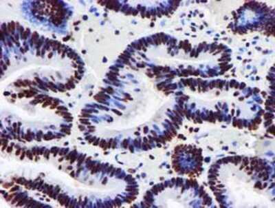 Immunohistochemistry-Paraffin: GSTT2 Antibody (3B6) [NBP2-03126] - Staining of paraffin-embedded Adenocarcinoma of Human colon tissue using anti-GSTT2 mouse monoclonal antibody.