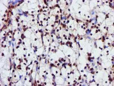 Immunohistochemistry-Paraffin: GSTT2 Antibody (3B6) [NBP2-03126] - Staining of paraffin-embedded Carcinoma of Human kidney tissue using anti-GSTT2 mouse monoclonal antibody.