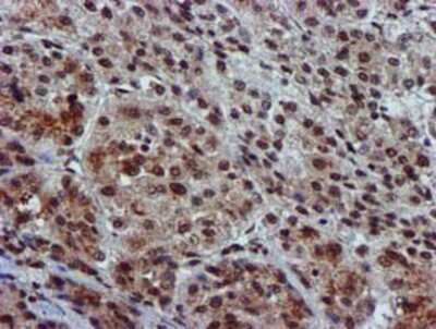 Immunohistochemistry-Paraffin: GSTT2 Antibody (3B6) [NBP2-03126] - Staining of paraffin-embedded Carcinoma of Human liver tissue using anti-GSTT2 mouse monoclonal antibody.