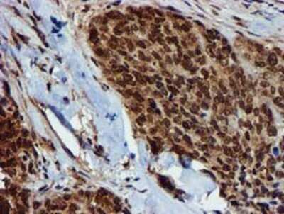 Immunohistochemistry: GSTT2 Antibody (OTI3B6) - Azide and BSA Free [NBP2-70861] - Staining of paraffin-embedded Adenocarcinoma of Human breast tissue using anti-GSTT2 mouse monoclonal antibody.