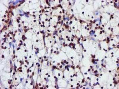 Immunohistochemistry: GSTT2 Antibody (OTI3B6) - Azide and BSA Free [NBP2-70861] - Staining of paraffin-embedded Carcinoma of Human kidney tissue using anti-GSTT2 mouse monoclonal antibody.