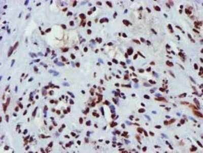 Immunohistochemistry: GSTT2 Antibody (OTI3B6) - Azide and BSA Free [NBP2-70861] - Staining of paraffin-embedded Carcinoma of Human lung tissue using anti-GSTT2 mouse monoclonal antibody.