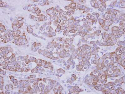 Immunohistochemistry-Paraffin: GTDC1 Antibody [NBP2-16759] - Immunohistochemical analysis of paraffin-embedded Breast ca, using antibody at 1:250 dilution.