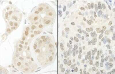 Immunohistochemistry: GTF2A1 Antibody [NBP1-46216] - Sample: FFPE section of human breast carcinoma (left) and mouse teratoma (right). Antibody: Affinity purified rabbit anti- GTF2A1/TFIIA used at a dilution of 1:1,000 (1ug/ml). Detection: DAB