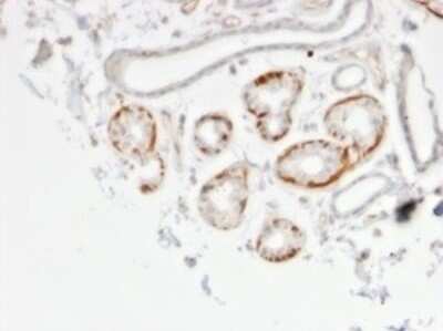 Immunohistochemistry-Paraffin: GTF2H2D Antibody (PCRP-GTF2H2C-2C9) [NBP3-08896] - Formalin-fixed, paraffin-embedded human breast carcinoma stained with GTF2H2D Mouse Monoclonal Antibody (PCRP-GTF2H2D-2C9).