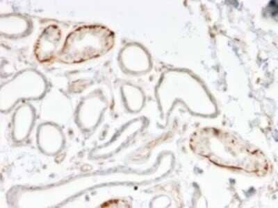Immunohistochemistry-Paraffin: GTF2H2D Antibody (PCRP-GTF2H2C-2C9) [NBP3-08896] - Formalin-fixed, paraffin-embedded human breast carcinoma stained with GTF2H2D Mouse Monoclonal Antibody (PCRP-GTF2H2D-2C9).