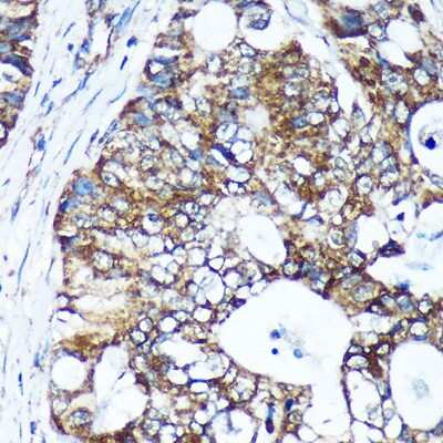 Immunohistochemistry-Paraffin: GULP1/CED-6 Antibody [NBP3-03258] - Immunohistochemistry of paraffin-embedded Human colon carcinoma using GULP1/CED-6 Rabbit pAb (NBP3-03258) at dilution of 1:100 (40x lens). Perform microwave antigen retrieval with 10 mM PBS buffer pH 7.2 before commencing with IHC staining protocol.