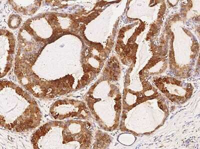 Immunohistochemistry: GW182 Antibody [NBP3-06657] - Immunochemical staining of human TNRC6A in human breast carcinoma with NBP3-06657 (1:300, formalin-fixed paraffin embedded sections).