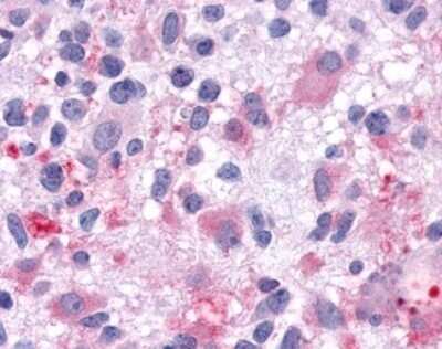 Immunohistochemistry-Paraffin: Galanin R1/GALR1 Antibody [NBP2-29491] - Analysis of anti-GALR1 / Galanin Receptor 1 antibody with human brain, glioblastoma.