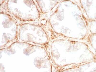 Immunohistochemistry-Paraffin: Galectin-1 Antibody (GAL1/2499R) - Azide and BSA Free [NBP2-79855] - Formalin-fixed, paraffin-embedded human Prostate Carcinoma stained with Galectin-1 Antibody (GAL1/2499R).