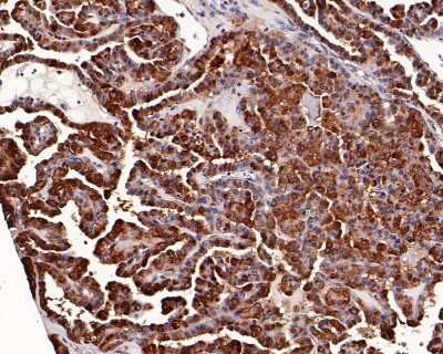 Immunohistochemistry-Paraffin: Galectin-3 Antibody (JF39-10) [NBP2-66857] - Analysis of paraffin-embedded human thyroid carcinoma tissue with Rabbit anti-Galectin-3 antibody washed with ddH2O and PBS, and then probed with the primary antibody  at 1/200 dilution for 1 hour at room temperature. The detection was performed using an HRP conjugated compact polymer system. DAB was used as the chromogen. Tissues were counterstained with hematoxylin and mounted with DPX.