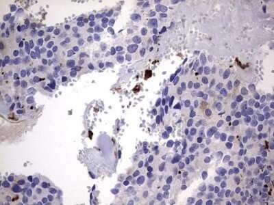 Immunohistochemistry: Galectin-3 Antibody (OTI1C7) - Azide and BSA Free [NBP2-71124] - Analysis of Adenocarcinoma of Human breast tissue. (Heat-induced epitope retrieval by 1 mM EDTA in 10mM Tris, pH8.5, 120C for 3min)