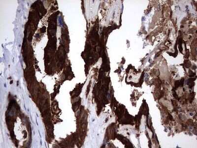 Immunohistochemistry: Galectin-3 Antibody (OTI1C7) - Azide and BSA Free [NBP2-71124] - Analysis of Adenocarcinoma of Human colon tissue. (Heat-induced epitope retrieval by 1 mM EDTA in 10mM Tris, pH8.5, 120C for 3min)