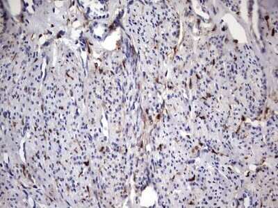 Immunohistochemistry: Galectin-3 Antibody (OTI1C7) - Azide and BSA Free [NBP2-71124] - Analysis of Adenocarcinoma of Human endometrium tissue. (Heat-induced epitope retrieval by 1 mM EDTA in 10mM Tris, pH8.5, 120C for 3min)